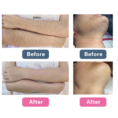 دستگاه ليزر پاکسازي مو 808 755nm 1064nm طول موج سه گانه