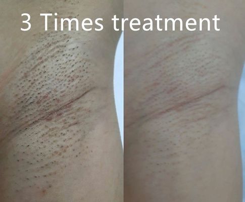 دستگاه لیزر موهای زائد چند منظوره با پشتیبانی از عرض پالس های مختلف برای کاهش دائمی موهای زائد