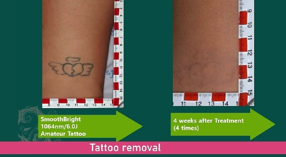 1064nm Q Switched Nd Yag Laser Picosecond دستگاه حذف خالکوبی سبک ثابت