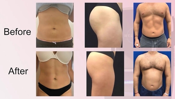 دستگاه لاغری EMS حرفه ای برای مراقبت از پوست
