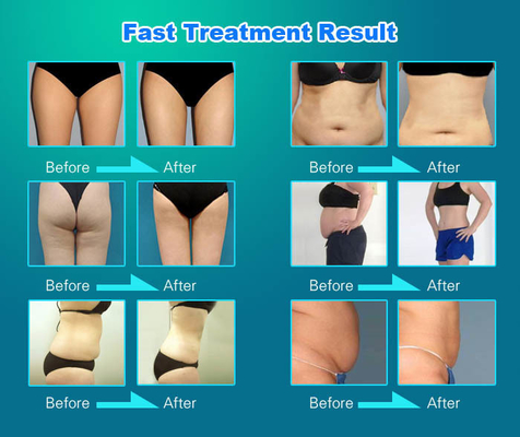 OEM / ODM Vela Slim Machine White Professional Body Contouring Machine ماشین کوچک و سبک سفید و حرفه ای