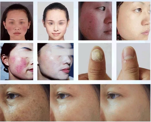 دستگاه 50W 980 Nm Diode Laser Spider Vein Removal برای درمان رگ های خونی