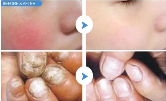 دستگاه 15W 30W لیزر برای درمان ناخن پا / احیای پوست با لیزر داغ